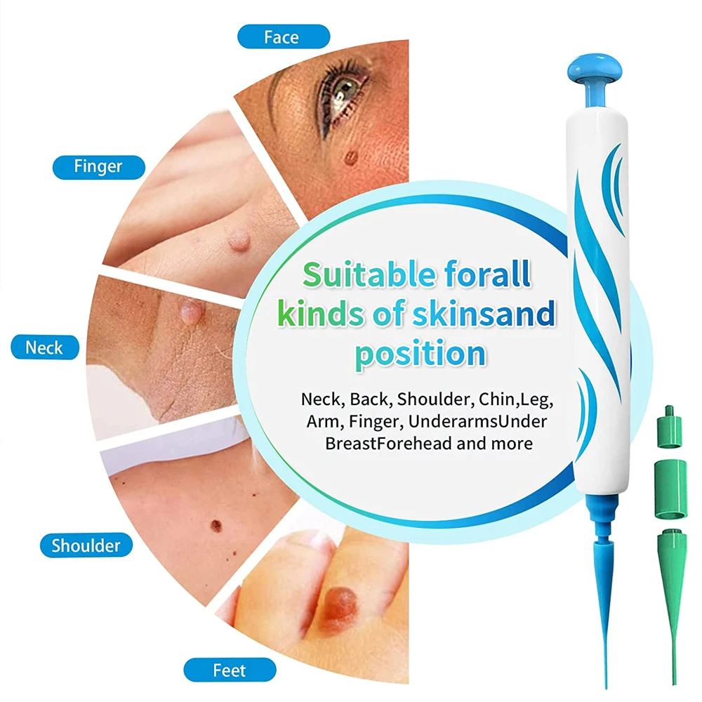 2 IN 1 Auto Micro Skin Tag Rem - Skincare Ingredients Checker ulasan dan harga